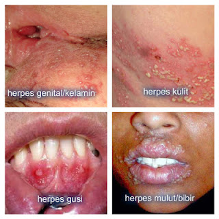 macam macam herpes macam macam herpes