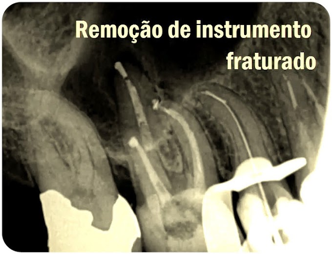 ENDODONTIA: Remoção de instrumento fraturado - Caso Clínico