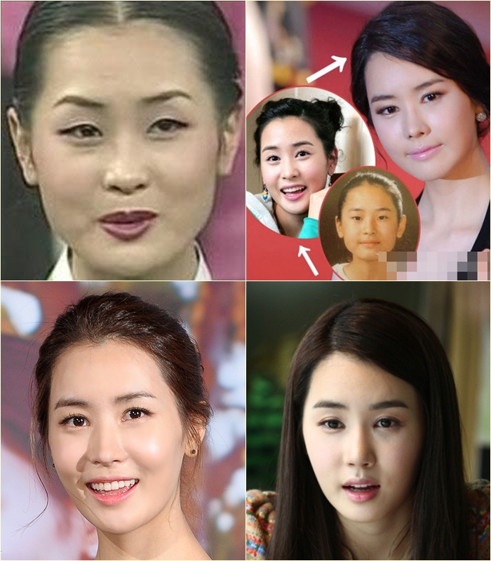 Lee Da Hae’s plastic surgery.