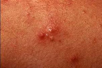 pimple causes, symptoms, and treatment | Share All Knowledge