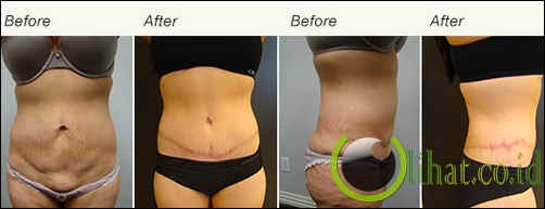 Full Body Lift sekitar Rp 409 juta - Rp 467 juta Full Body Lift sekitar Rp 409 juta - Rp 467 juta