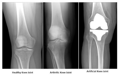 total joint replacement surgeon best othopedic doctor in cavite