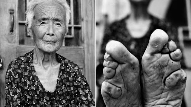 Lotus Feet, Tradisi Ekstrim Untuk Bentuk Yang Cantik Dengan Cara Yang Pasti Membuat Kamu Ngilu Lotus Feet, Tradisi Ekstrim Untuk Bentuk Yang Cantik Dengan Cara Yang Pasti Membuat Kamu Ngilu
