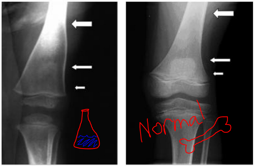 Erlenmeyer Flask Deformity