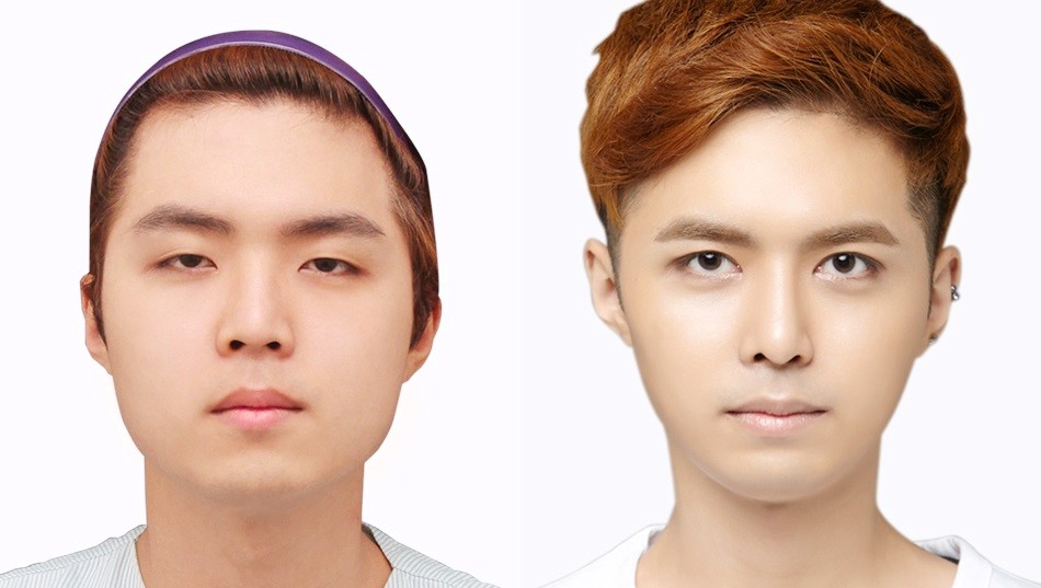 The Price for Male Plastic Surgery in Korea