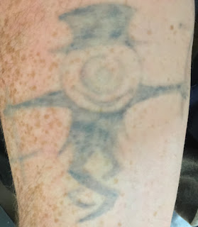Tattoo Fading Tattoo moments before Picosure laser removal
