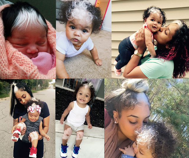 Exclusive This Little Girl Have A White Patch Of Hair When She