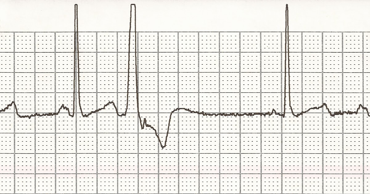 ectopic beats anxiety ectopic beats anxiety