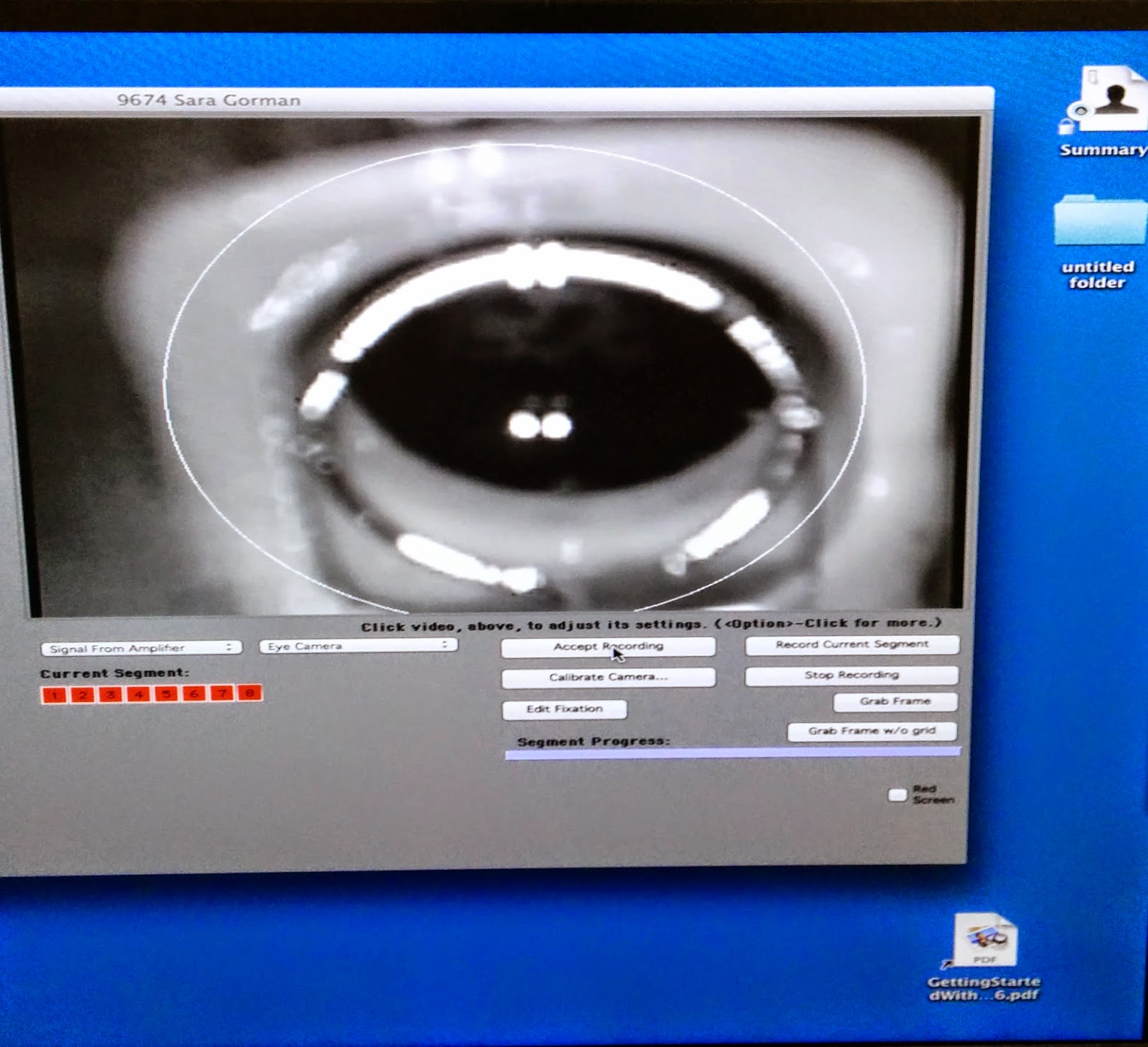 ERG test Advancements in eye exams to test for plaquenil toxitity