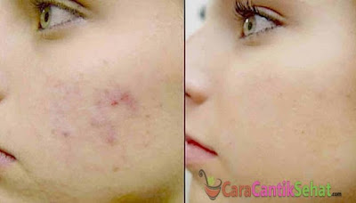 cara menghilangkan bekas jerawat atau flek hitam cara menghilangkan bekas jerawat atau flek hitam