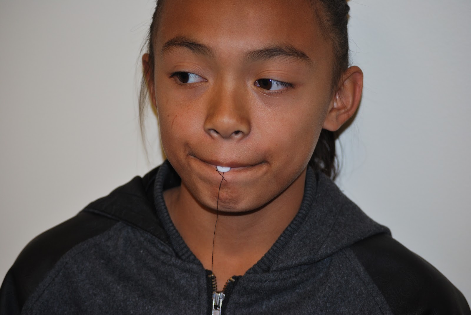 Myofunctional Therapy OroFacial Muscle ReEducation