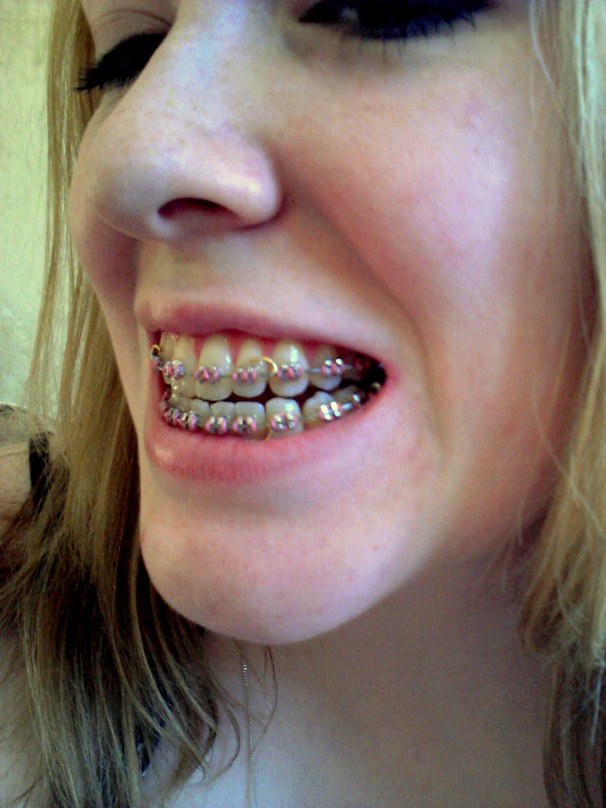 My Jaw Surgery One Month been and gone! Day 32 Before and Afters Photos!