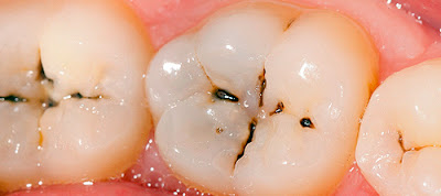 Răng không bị sâu bọc răng sứ có lấy tủy không?