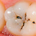 Răng không bị sâu bọc răng sứ có lấy tủy không?
