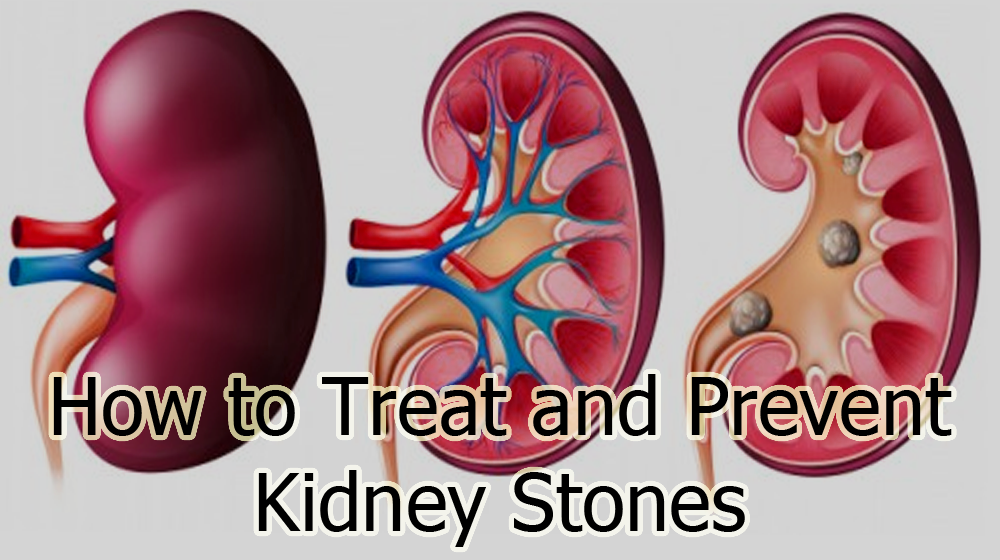 How to Treat and Prevent Kidney Stones