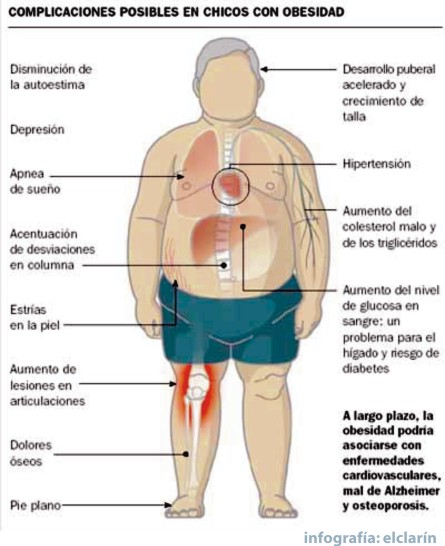 Obesidad infantil y sus consecuencias Obesidad infantil y sus consecuencias