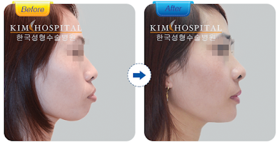 Hiệu quả phẫu thuật hàm hô không cần niềng răng tại nha khoa KIM Hiệu quả phẫu thuật hàm hô không cần niềng răng tại nha khoa KIM