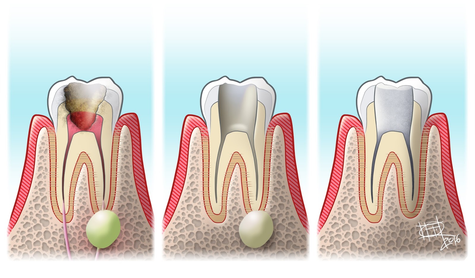 Que significa endodoncia