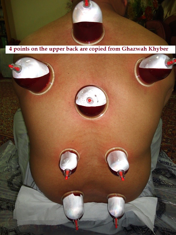 hijama cu puncte varicoase