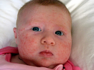 Acne De Bebe Causas y Medidas