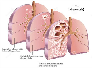 Obat Tradisional TBC Akut