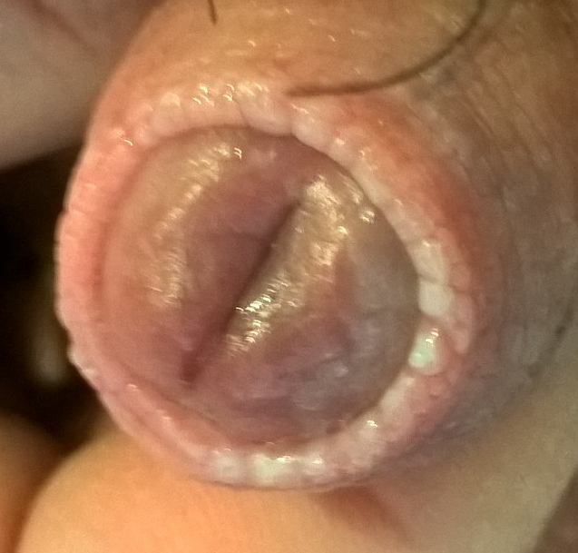 cosmetic adult circumcision hight and tight as ate her i in mouth pissed pussy she