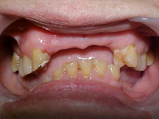 Mất răng nguyên hàm