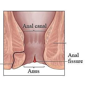 Definition: An anal fissure is a cutaneous tear in the ectodermal portion of the anal canal and is usually found in the postero-lateral wall or in other ... My Family Medicine Practice: Brief Summary About Anal Fissure