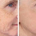 Best Way to Remove Wrinkles ( Wrinkles Reduce Home Remedies )