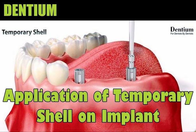 DENTIUM: Application of Temporary Shell on Implant