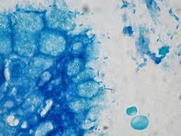 Tragically the phrase Mesothelioma is turning into increasingly good Mesothelioma Article - Asbestos Tailings Placed Round Mine Houses