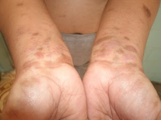 Foto Izaura primeira postagem no AMIGOS DA CURA - curada de liquen pela autohemoterapia - foto 5