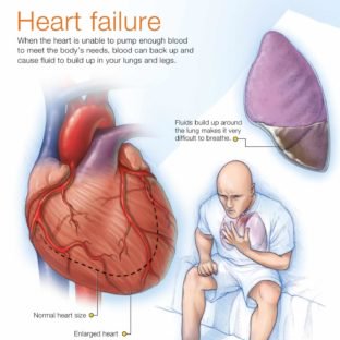 Prevent Heart failure PZ advocates healthy heart for Nigerians