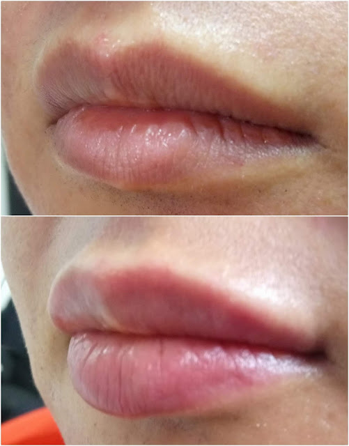 What Is The "Lip Filler Injection" / "Lip Filling" / "Lip Augmentation With Filler" - Why Lip Filler Injection Be Done? - Which Lip Filler Materials Include? - Which is the Best Lip Filler Material? - Risks and Complications of Lip Filler Procedures - Risks of Lip Fillers: - Pay attention to the risks of silicon-containing fillers! - Biopolymers (Liquid Silicon) - Risks of Biopolymer Liquid Silicone Lip Injections - Lip Filler Injection Unfavorable Conditions - How Long Does The Lip Filler Effect Last? - How Much is the Lip Filler Injected For Per Procedure? - Lip Filler Misuse - Is Lip Filler Injection is Hurt or Painful? - How Many Minutes Does The Lip Filler Procedure Last? - Lip Filler Injection For Determining Cupid's Bow (Cupid's Spring) - After Care Instructions for Lip Fillers in Istanbul - Wait For 2 or 3 Weeks For Lip Filler Effect! - Cost Lip Filler Augmentation in Istanbul - Permanent Lip Filler Injection
