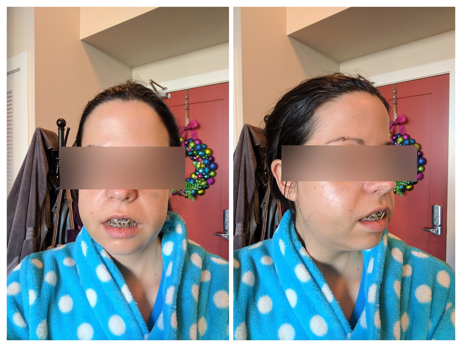 My Story Double Jaw Surgery and Septoplasty Photos