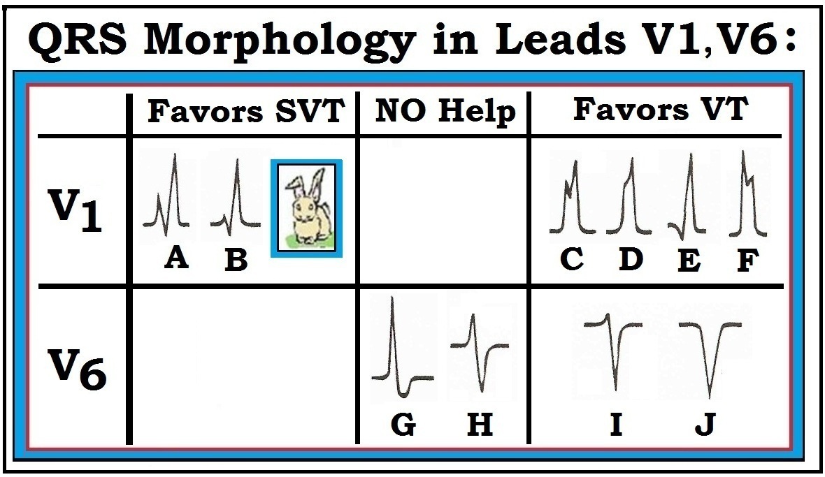 ECG Interpretation ECG Interpretation Review 42BIS (Tables and Figures for Blog 42)