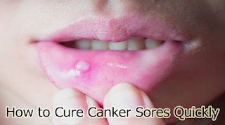 How to Cure Canker Sores Quickly