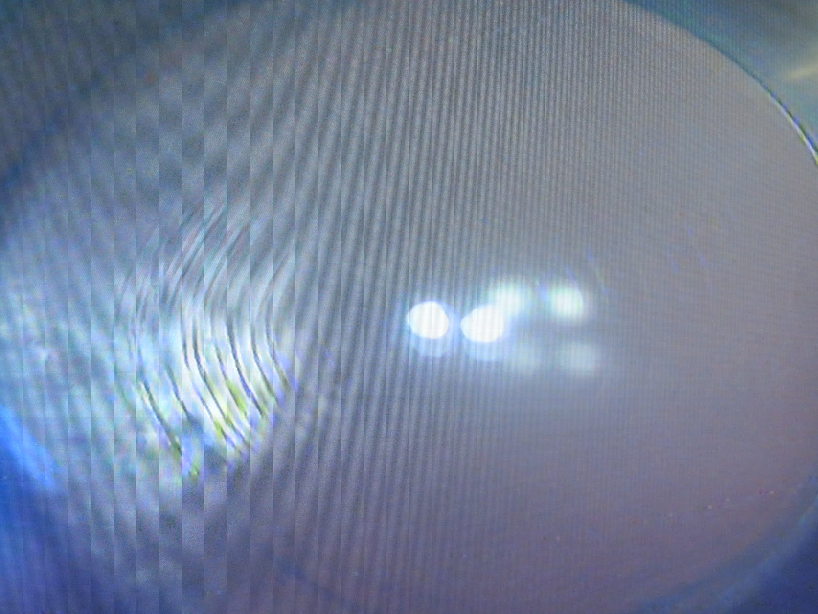 Zepto Cataract Surgery and TRiDIFF Trifocal IOL in intumescent Cataract