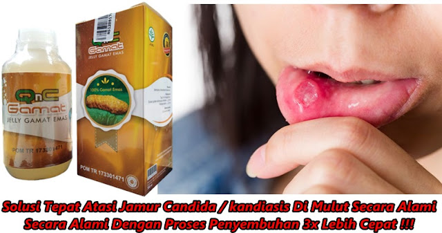 Cara Menghilangkan Jamur Candida Di Mulut Secara Alami Cara Menghilangkan Jamur Candida Di Mulut