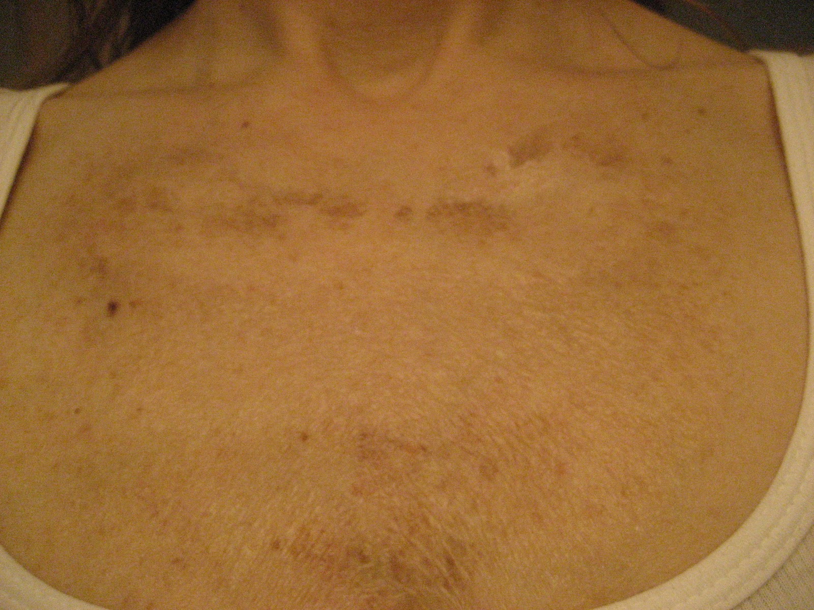 Chemical Peels for Acne and Anti Aging TCA Chest Peel