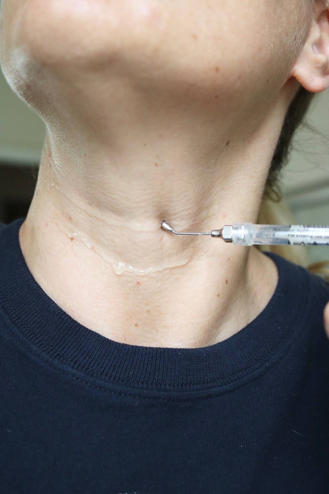 FILLERINA NECK AND CLEAVAGE TREATMENT REVIEW WITH BEFORE/AFTER