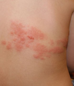 how long does it <a href="https://digitales.com.au/blog/wp-content/review/anti-herpes/aciclovir-for-shingles-dose.php">this web page</a> to completely recover from shingles