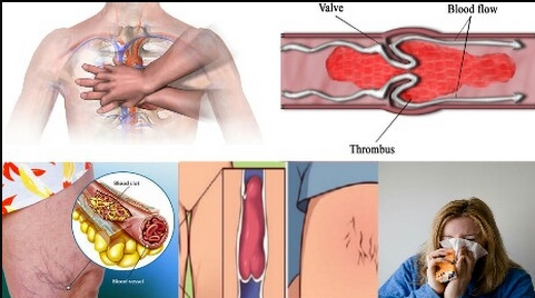 6 Signs That You Have A Blood Clot: Examine Yourself As Soon As Possible Before It's Too Late 
