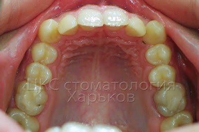 Трапецевидная форма зубного ряда