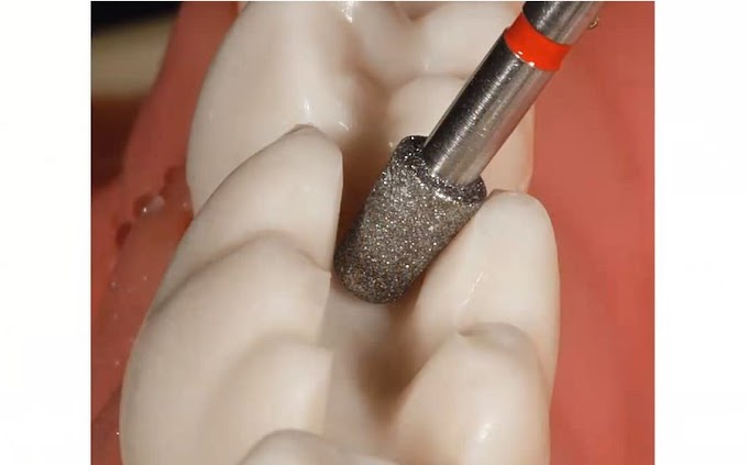 DENTAL MATERIALS: How to Complete Ceramic-Inlay and Partial-Crown Preps with Expert Kit 4562ST