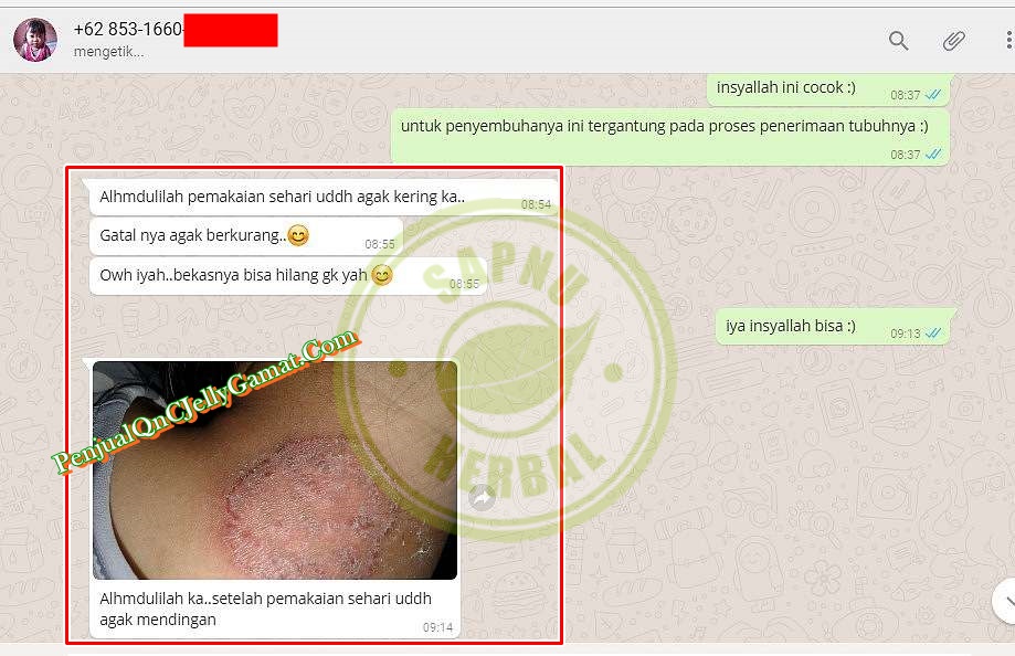 Cara Menghilangkan Bekas Koreng Yang Sudah Lama dan Menghitam Sampai Tuntas Cara Menghilangkan Bekas Koreng Yang Sudah Lama dan Menghitam Sampai Tuntas