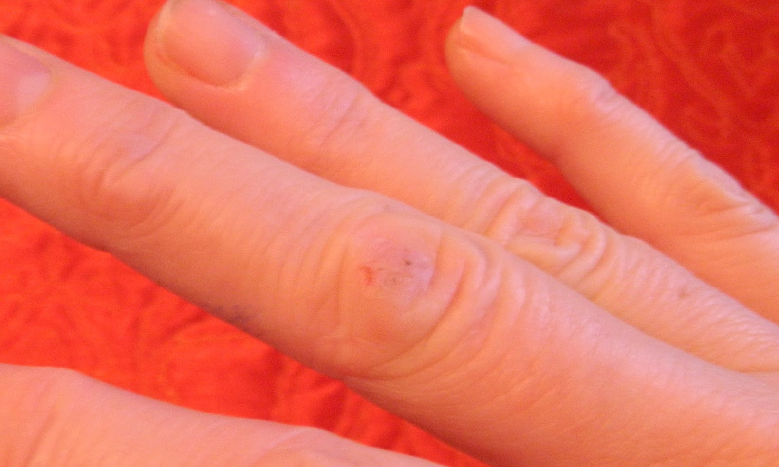 Causes of Tiny, Red Bumps on Fingers | LIVESTRONG.COM