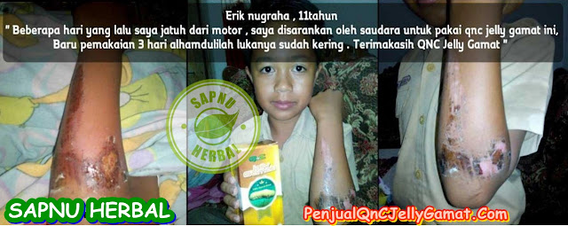 Cara Ampuh Mengobati Impetigo Secara Total Cara Ampuh Mengobati Impetigo Secara Total