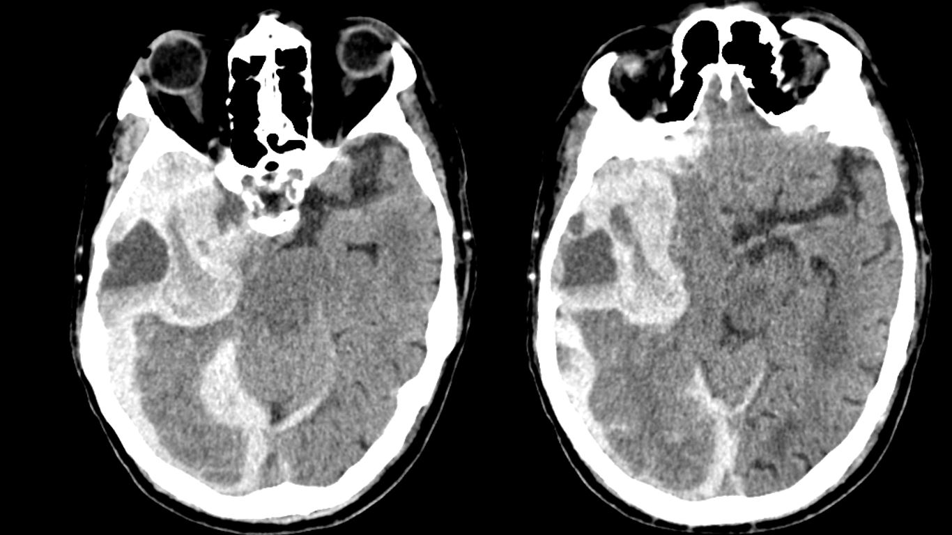 ultimate-radiology-acute-intracranial-hemorrhage-with-blood-fluid-level