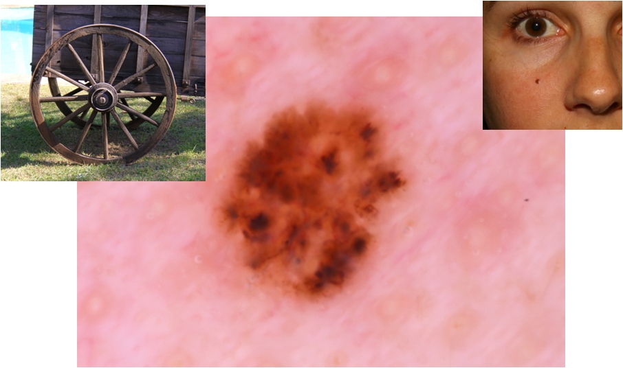 Dermatoscopia Spoke wheel areas